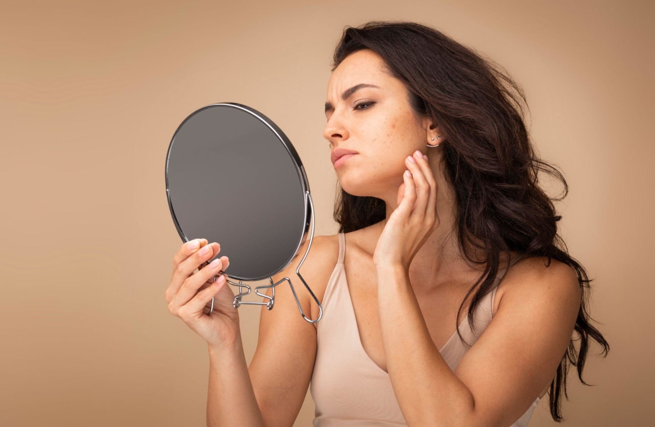 L’alcol provoca l’acne?