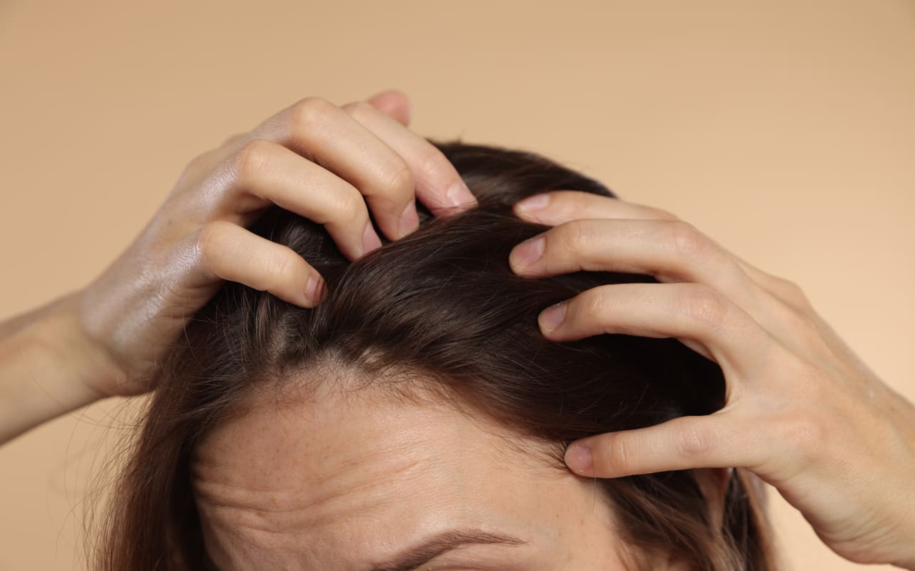Cuir chevelu qui démange : comment le soulager naturellement ?