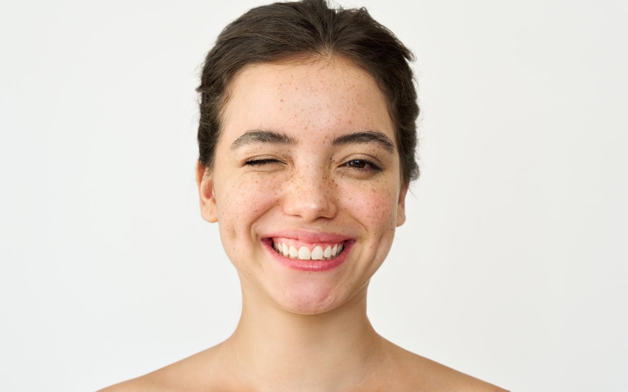 Pourquoi a-t-on des taches de rousseur ?