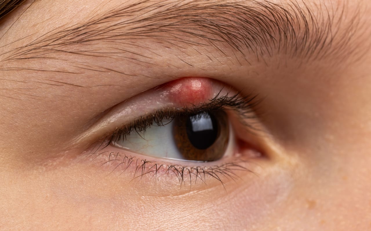 Chalazion : causes et symptômes