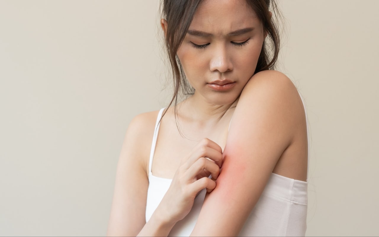 Tout savoir sur l'allergie aux piqûres de guêpe