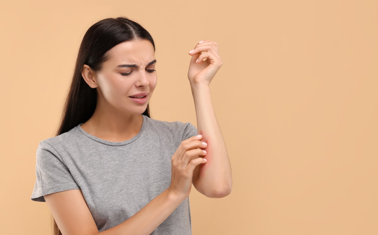 Soulager naturellement l'eczéma variqueux ou eczéma des jambes 