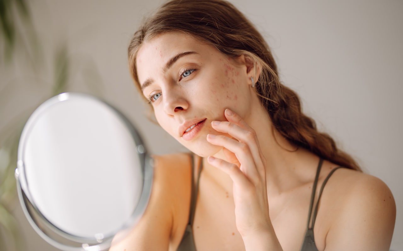 Acné sous-cutanée : quelles solutions naturelles ?