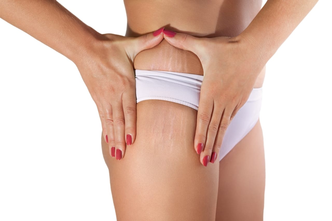 Comment prévenir les vergetures chez les femmes ?