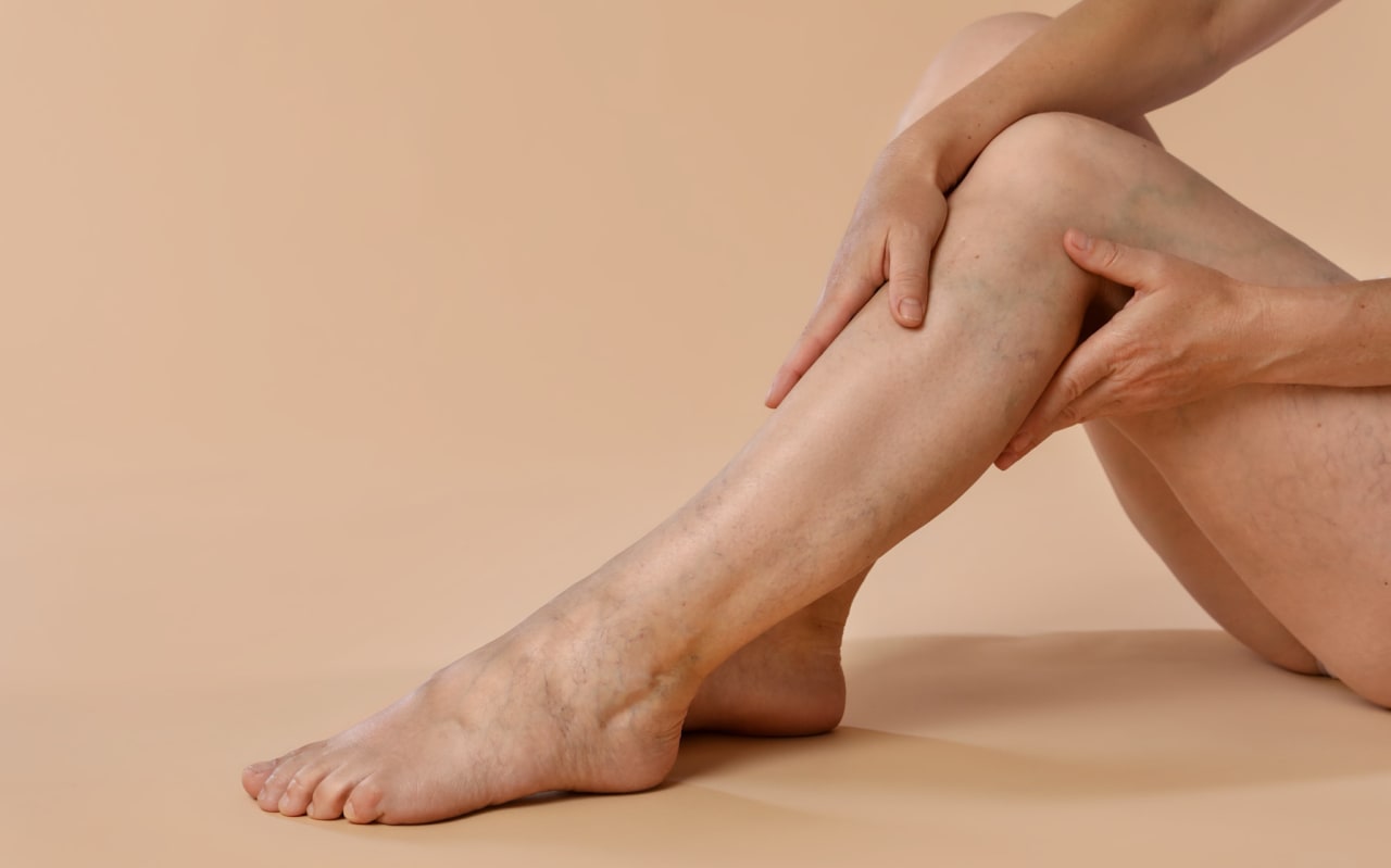 Varices aux jambes : Quelles solutions naturelles ?