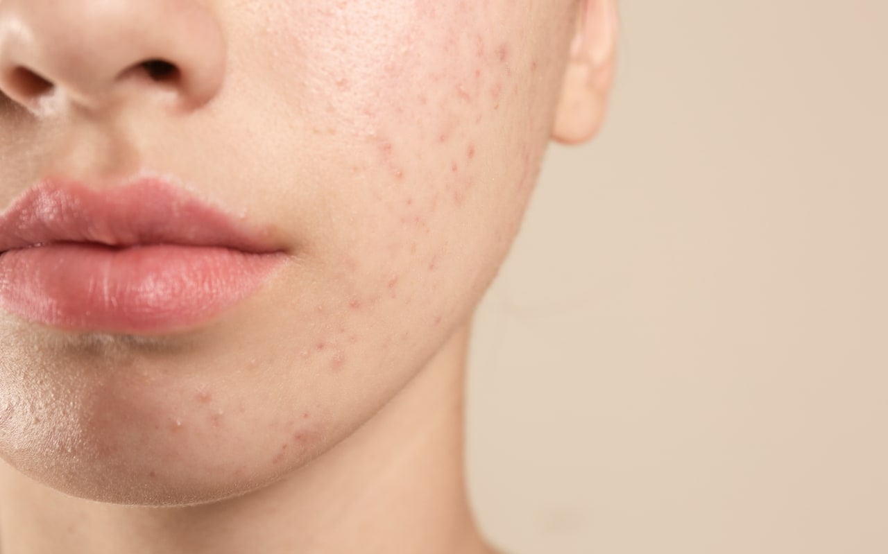 Acide mandélique pour la peau : quels bienfaits ?