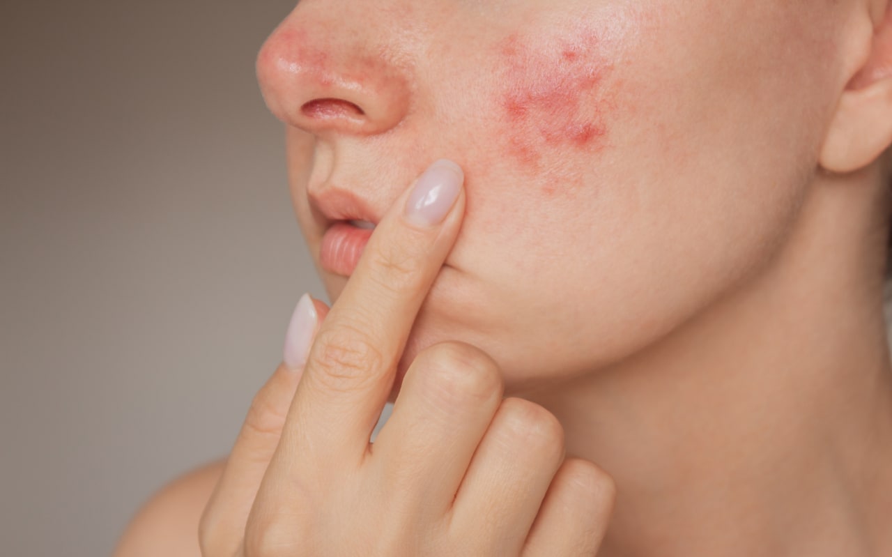 Qu'est-ce qu'une pustule ?