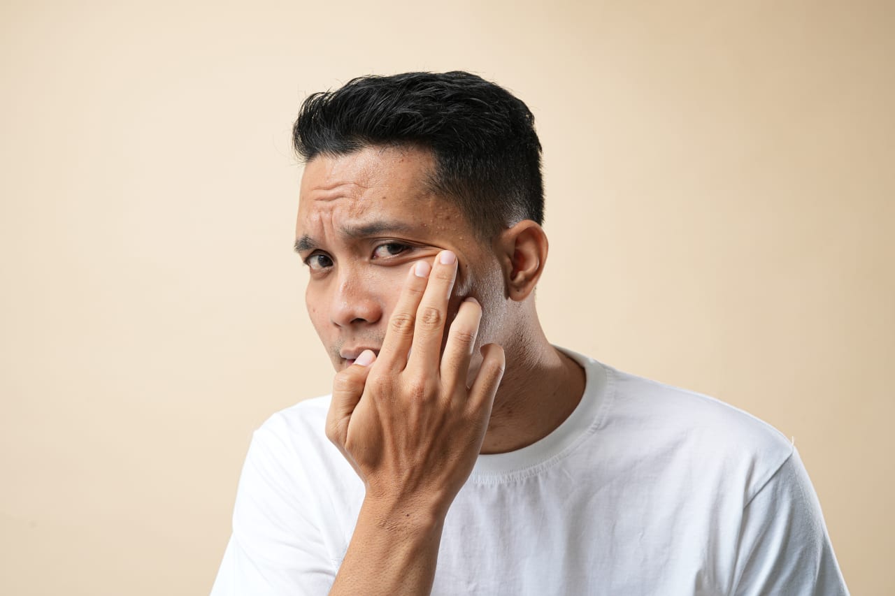 Quelles solutions naturelles pour atténuer l'acné rétentionnelle ?