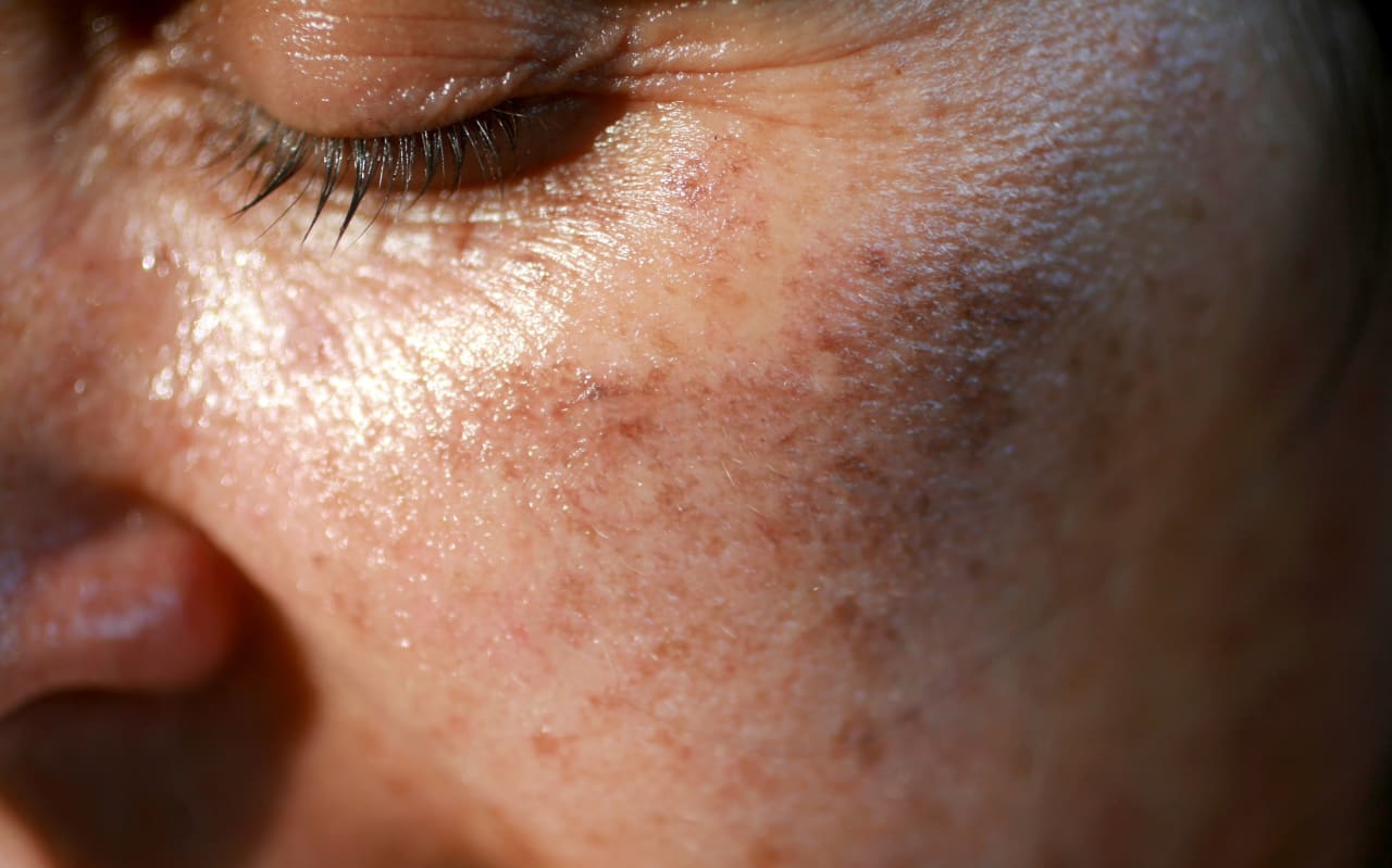 Macchie sul viso: cause, prevenzione e rimedi naturali