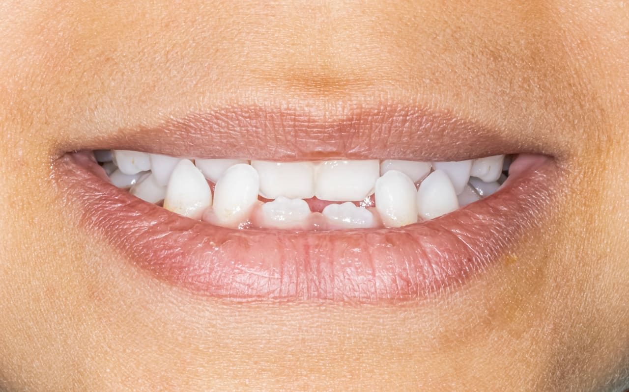 Malocclusion dentaire : qu'est ce que c'est ?