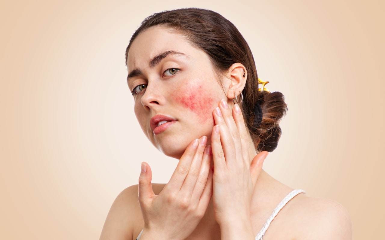 Erythrose : causes et symptômes