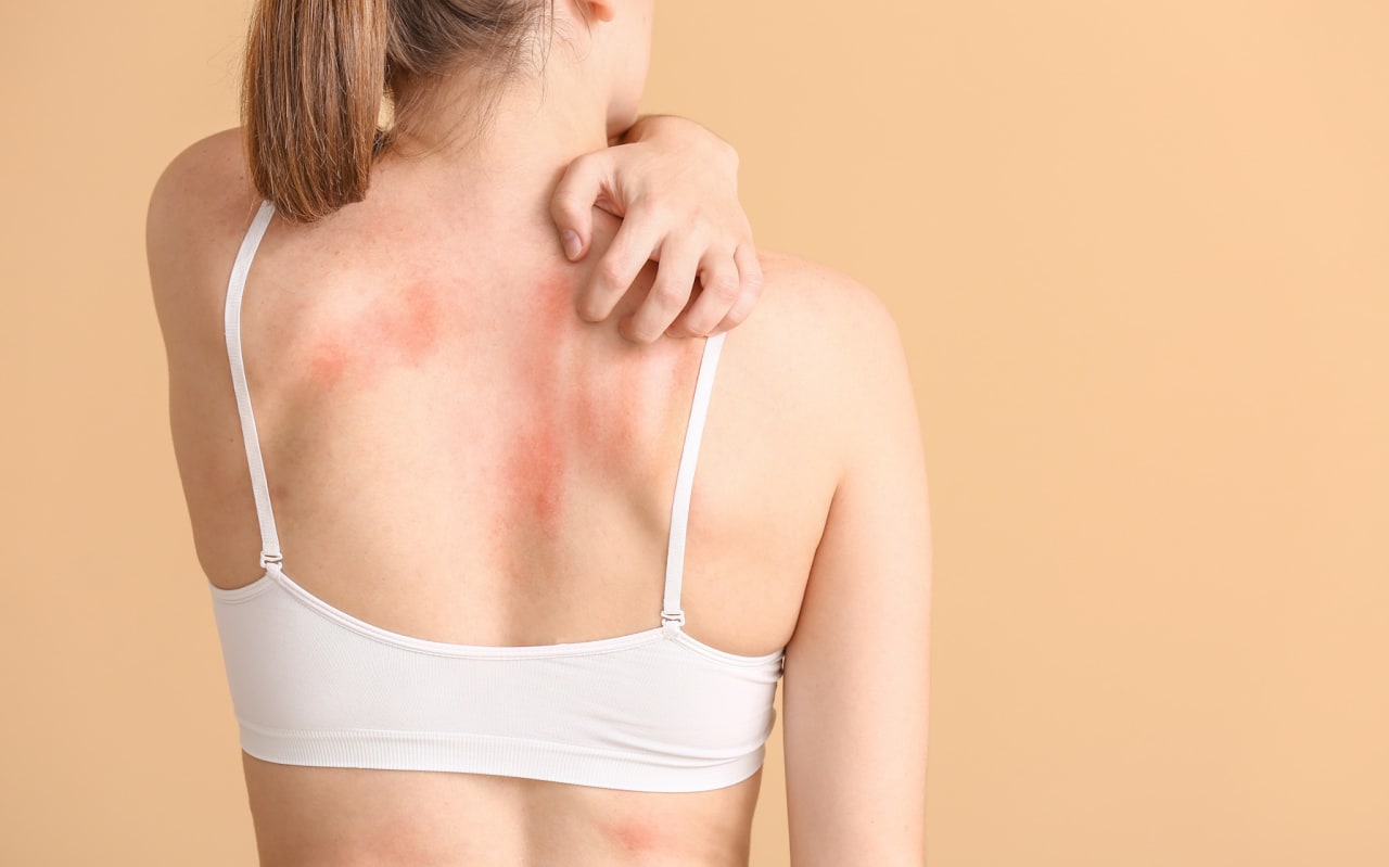 Irritation de la peau : solutions naturelles pour une routine apaisante