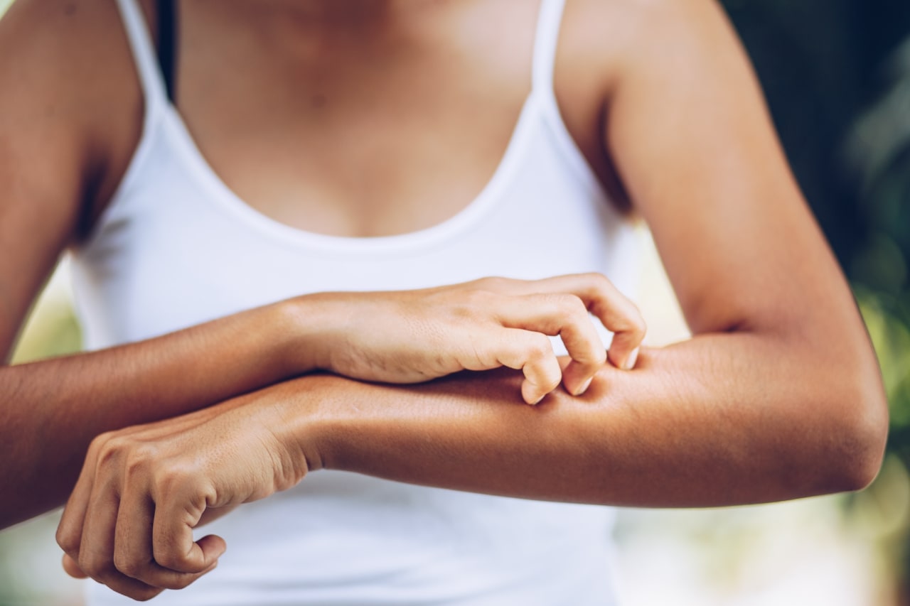Peut-on s'exposer au soleil avec de l'eczéma ?