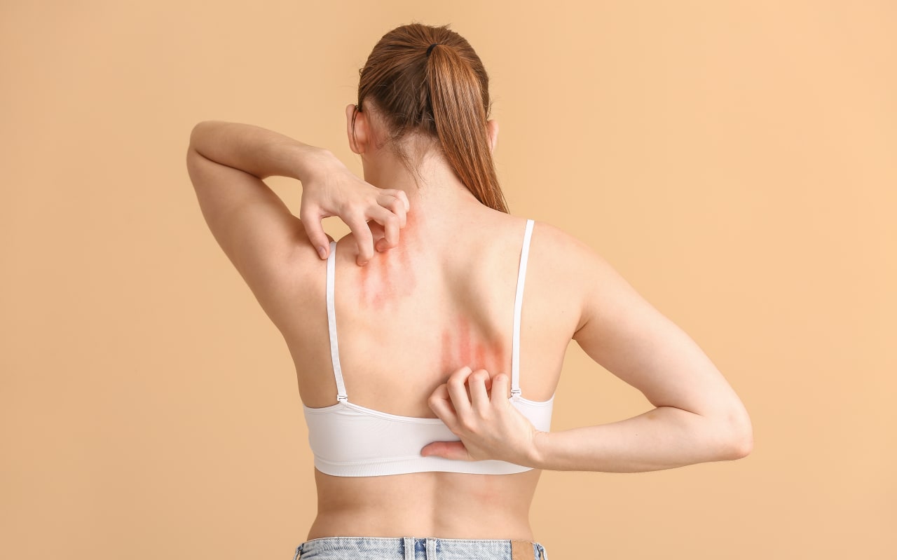 Eczema: i rimedi naturali più efficaci