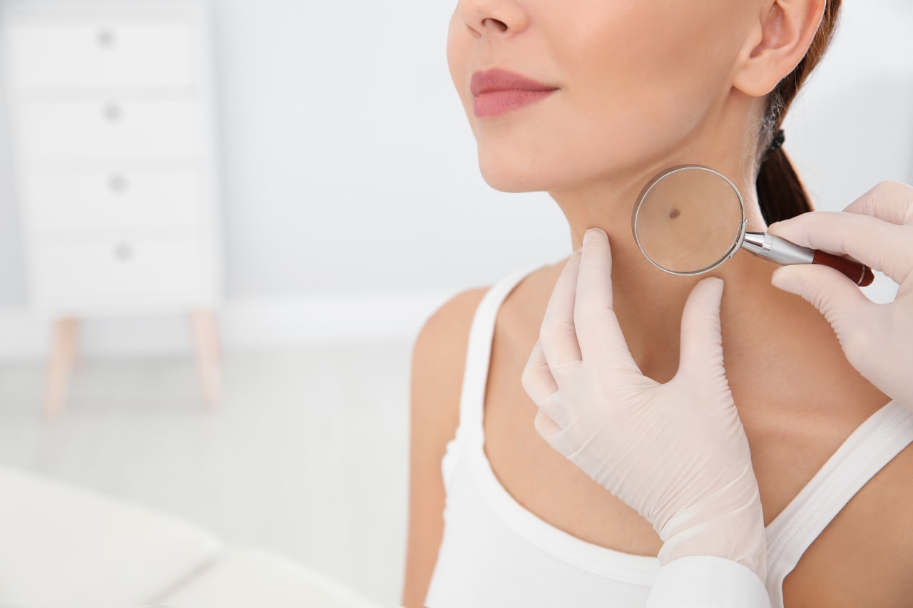 Seborrheic keratosis: Causes and symptoms