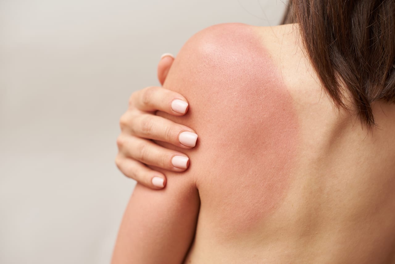 Comment apaiser un coup de soleil en une nuit ?