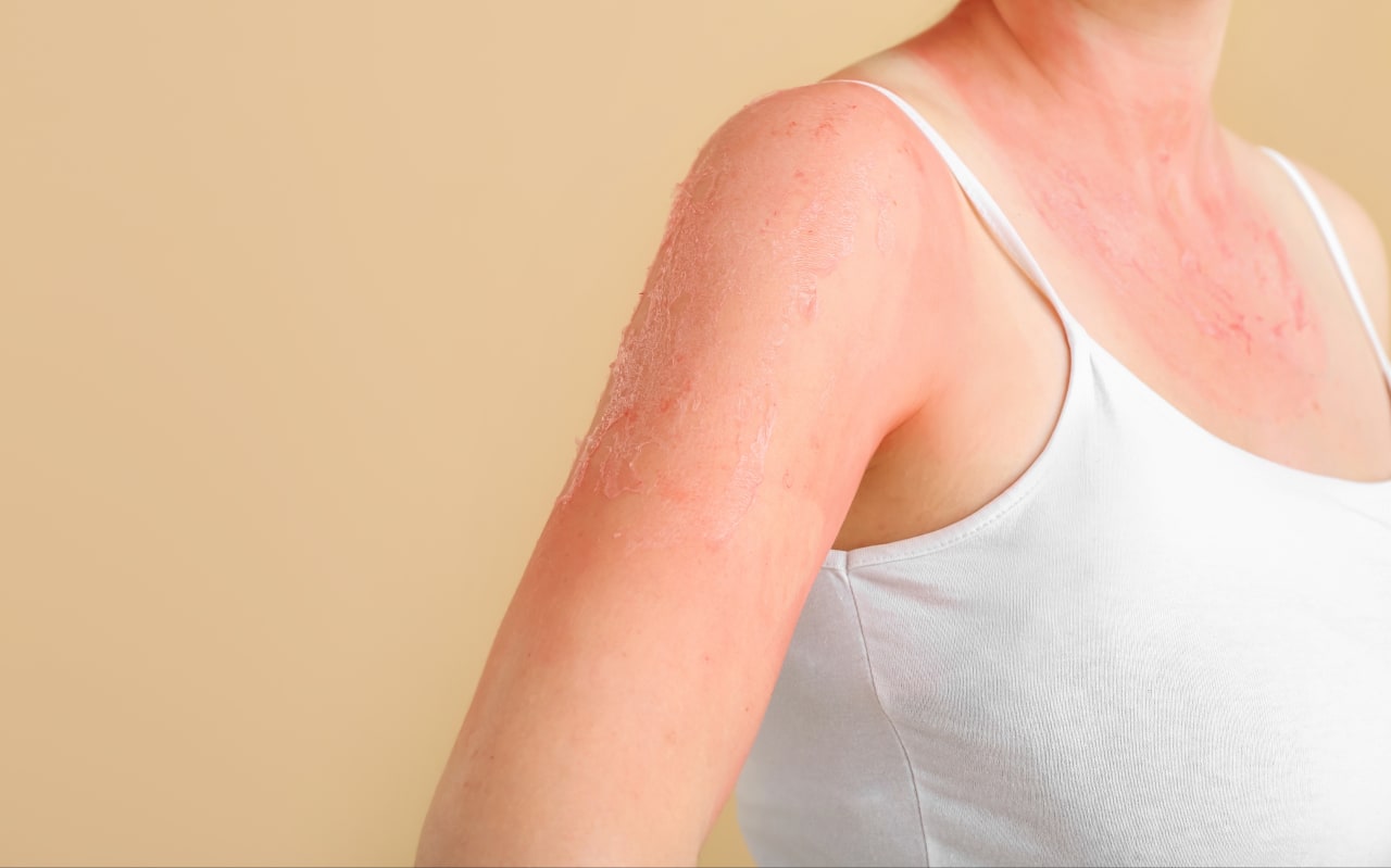 Quels sont les 4 types d'allergies ?