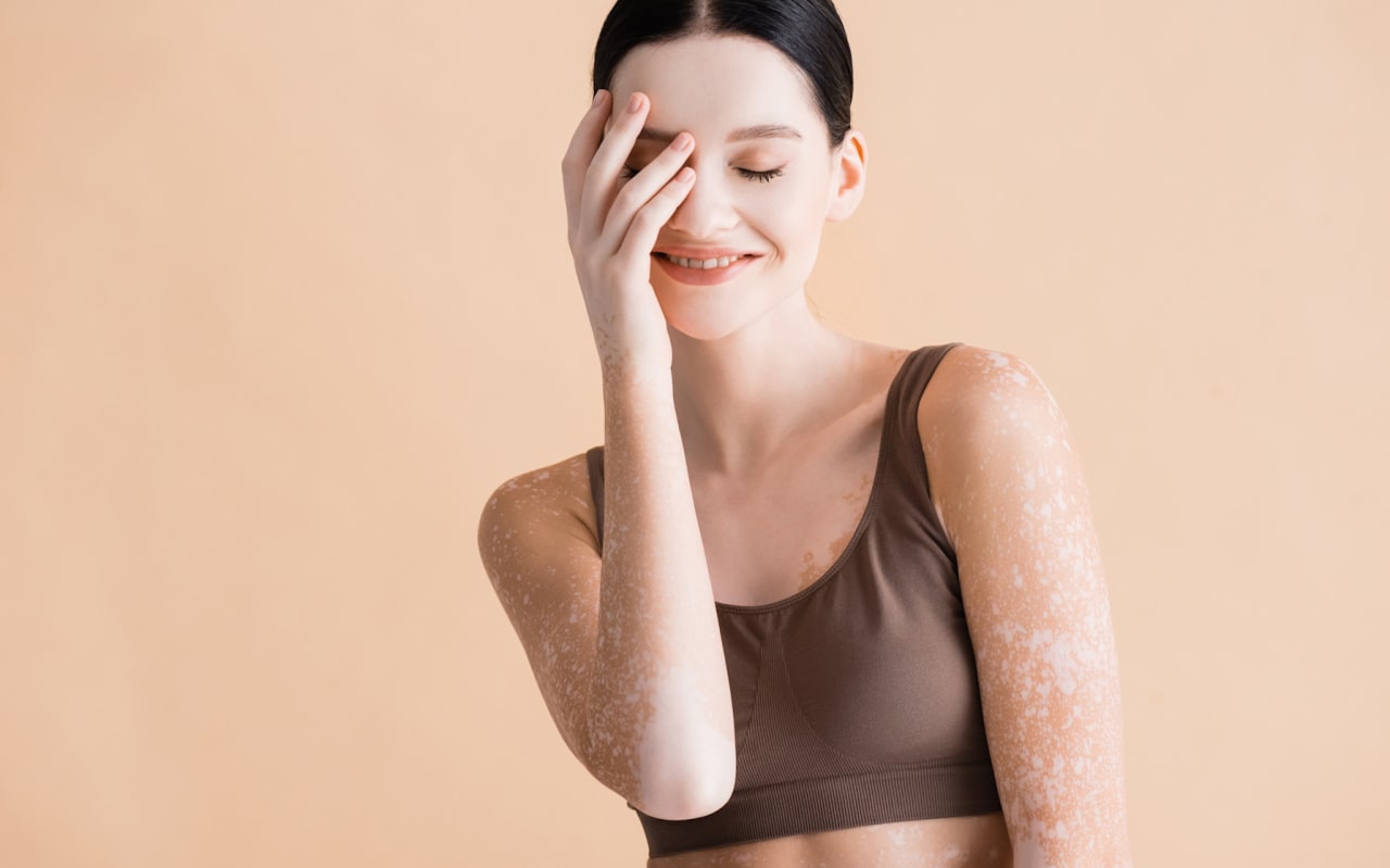 Dépigmentation de la peau : Tout savoir 