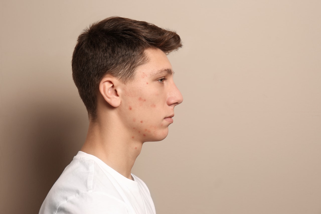 Comment traiter naturellement les boutons de stress ?
