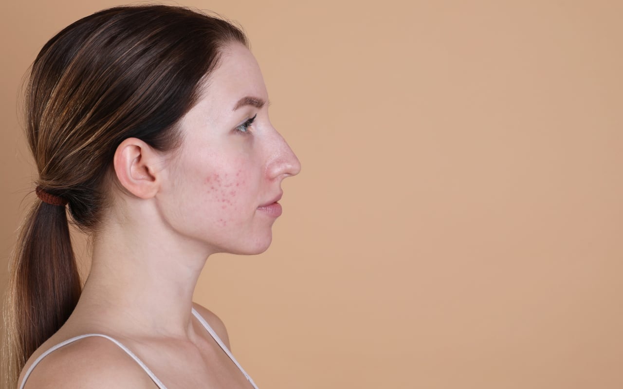 Comment se débarrasser des cicatrices d'acné ?