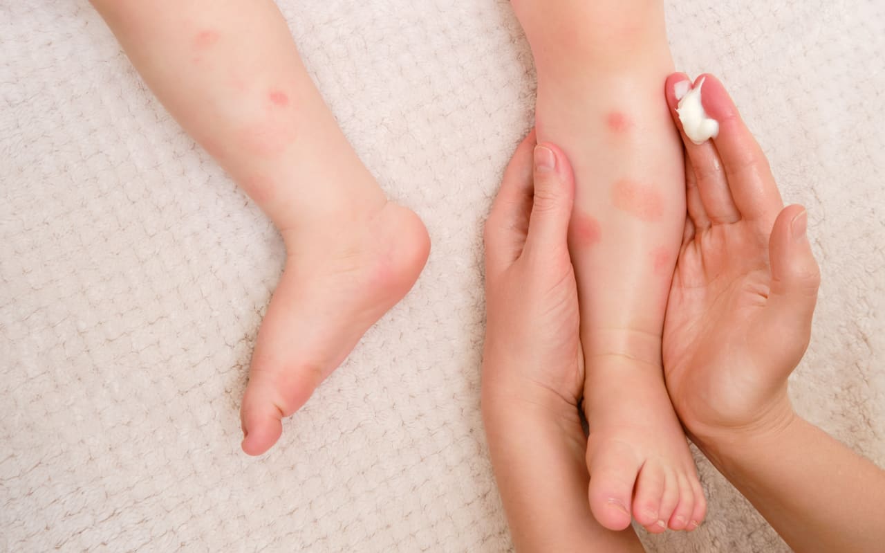 Peau atopique bébé : que préconiser ?