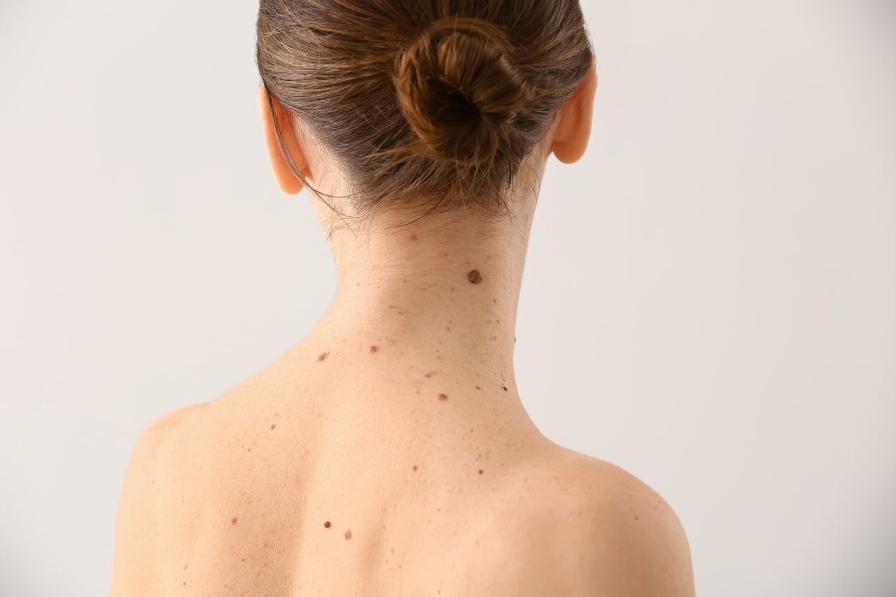 Acrochordon: come eliminarlo in modo naturale?