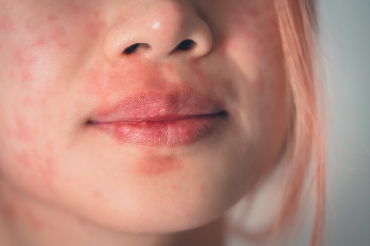 Que faire en cas d'eczéma autour de la bouche ?