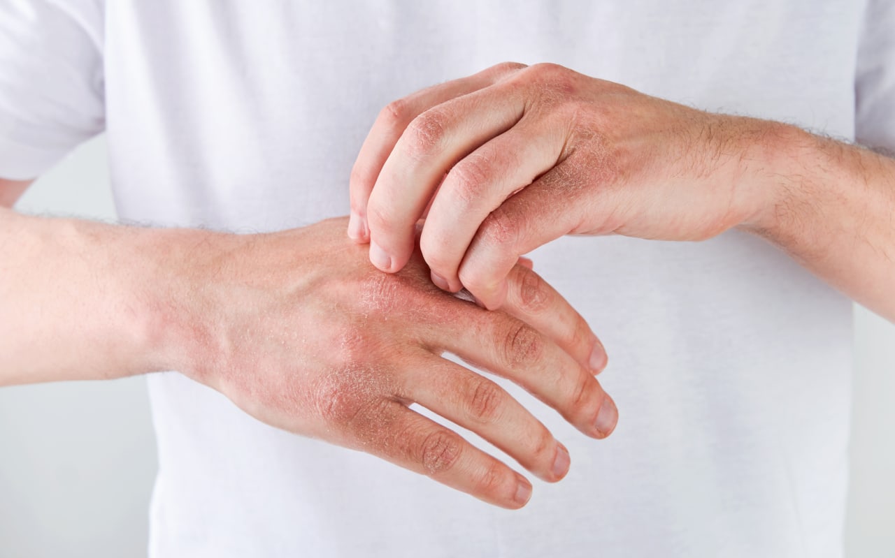 L'Eczéma dyshidrosique : symptômes, causes et solutions naturelles