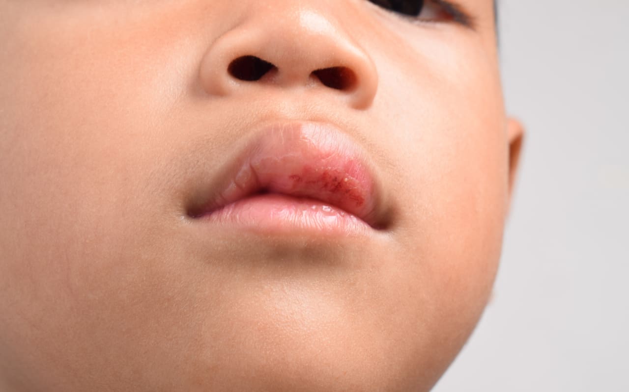 Allergie aux lèvres : causes et symptômes 