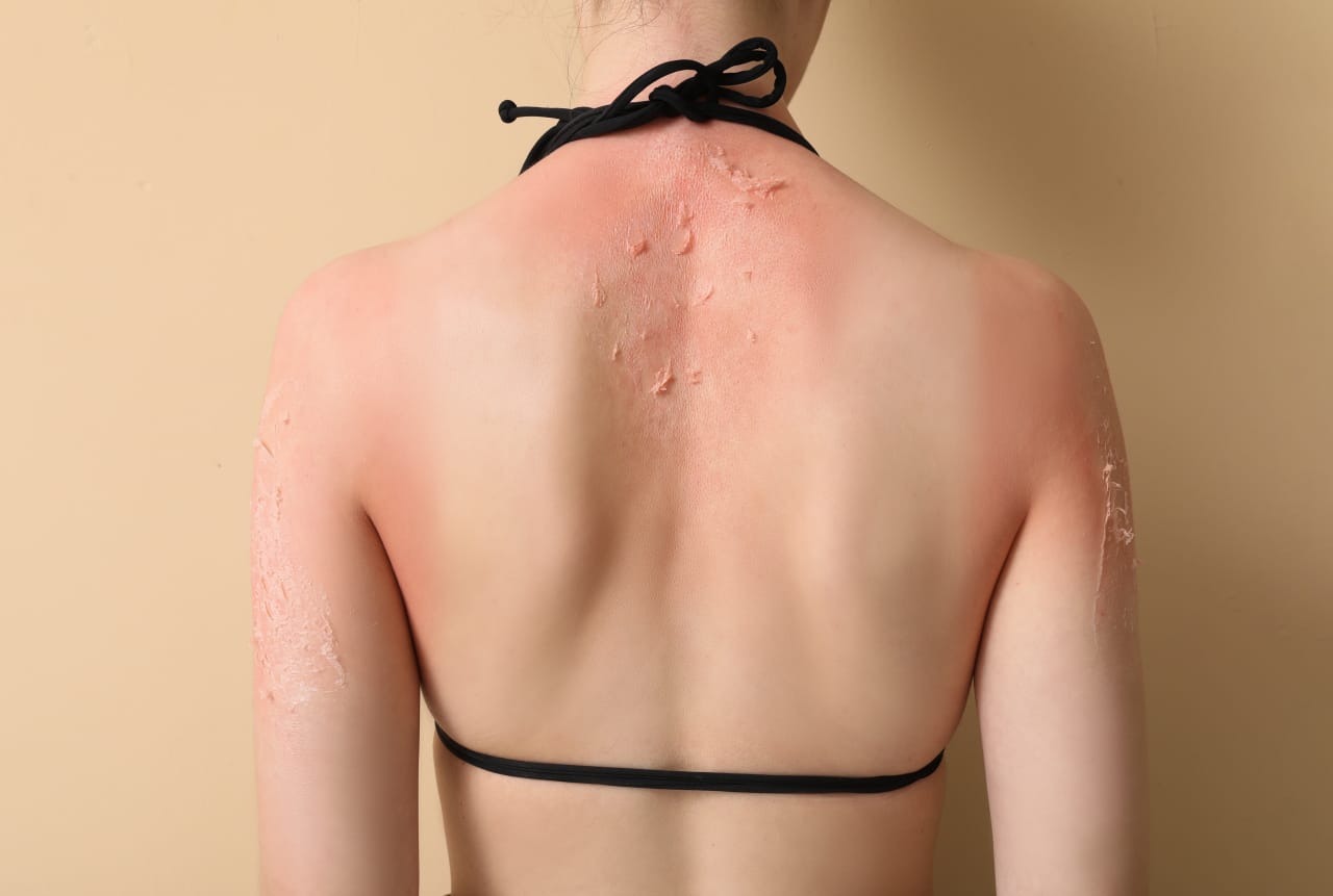 Allergies et réactions au soleil : prévention et astuces 