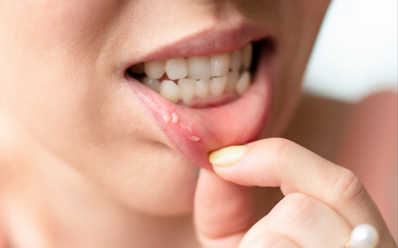 Ulcère à la bouche : causes et symptômes ?
