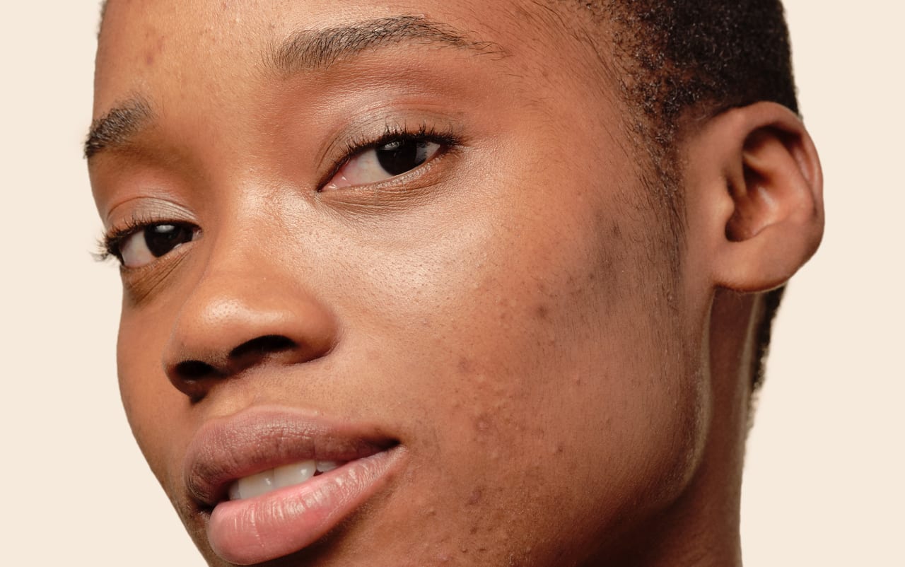 Boutons sur le visage : Nos solutions naturelles