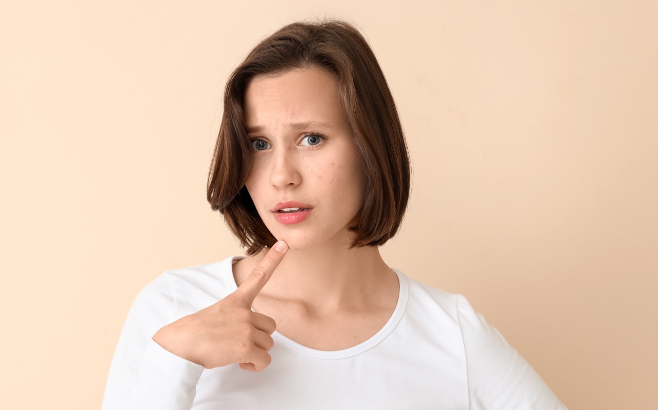 Acné post fêtes de fin d'année : nos astuces et solutions naturelles