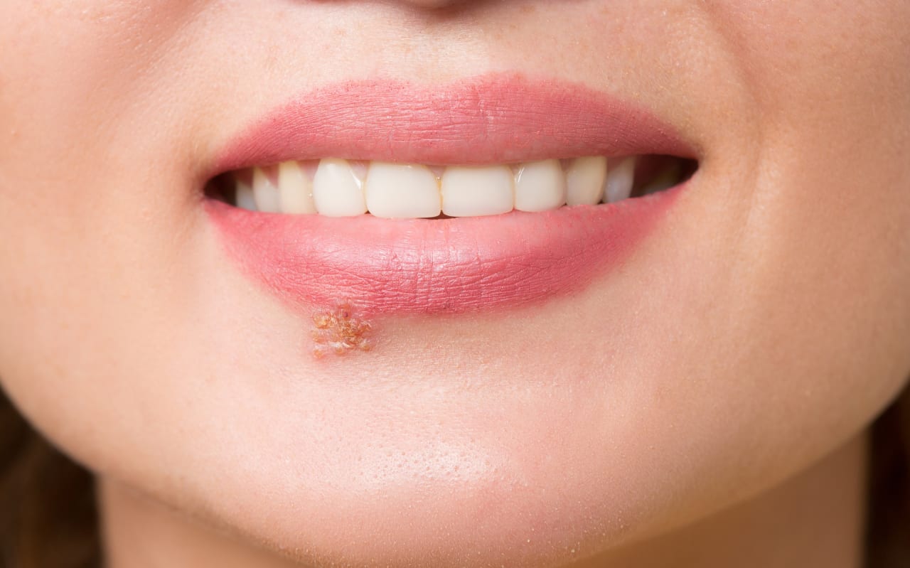 Herpès labial : Causes et symptômes ?