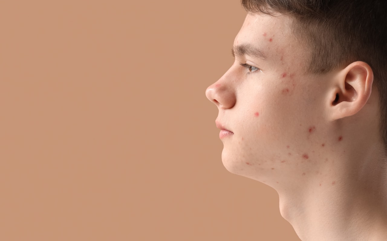 Hypothyroïdie et acné : quel lien ?
