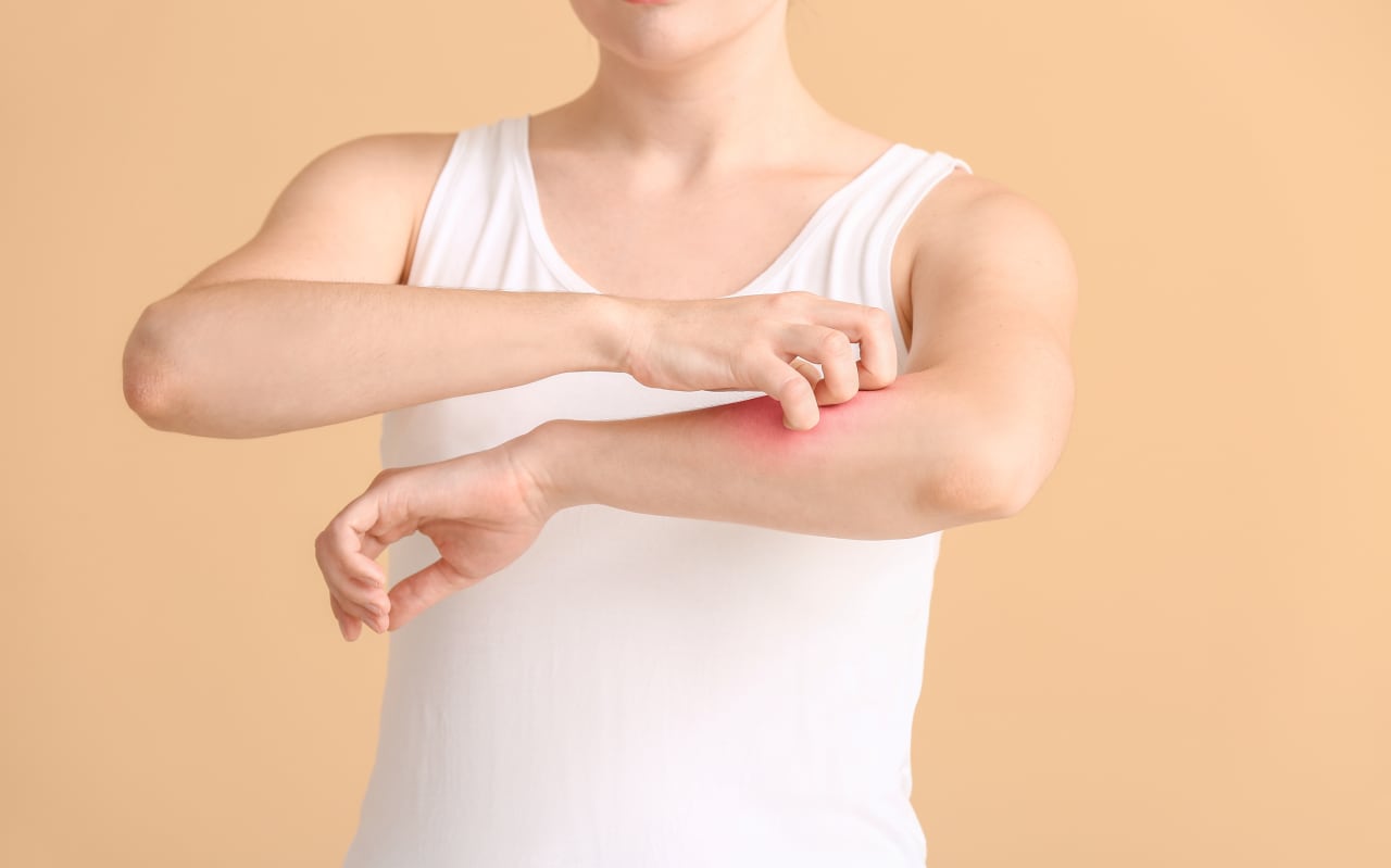 Plaques d'eczéma : quelles solutions naturelles ?