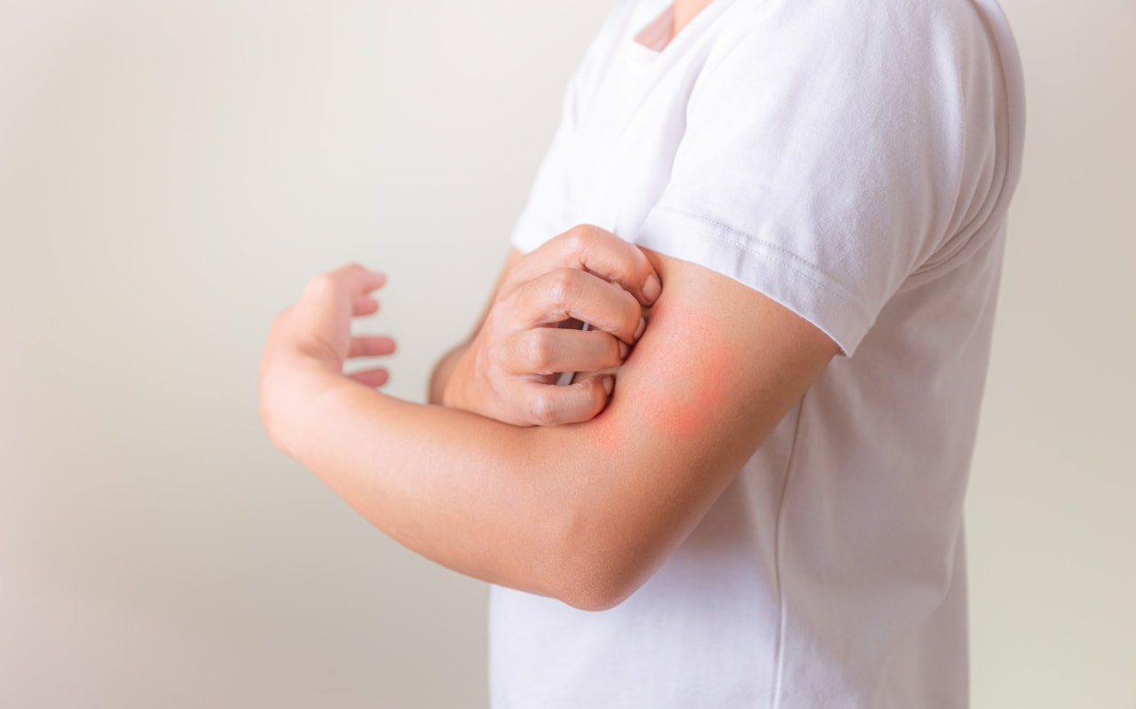 Piqûre de vive : Causes et symptômes