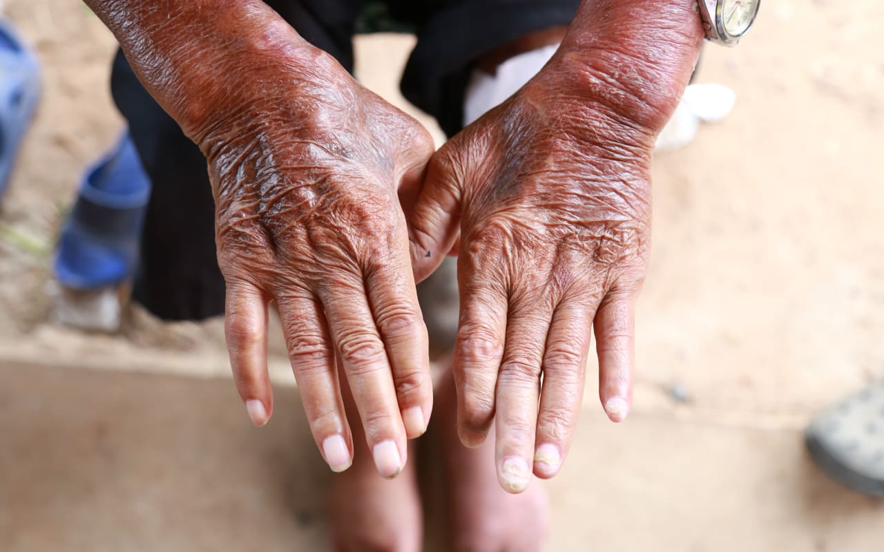 Morphea : Causes et symptômes ?