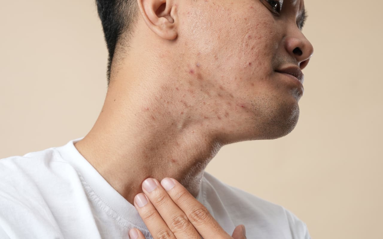 Furonculose : causes et symptômes