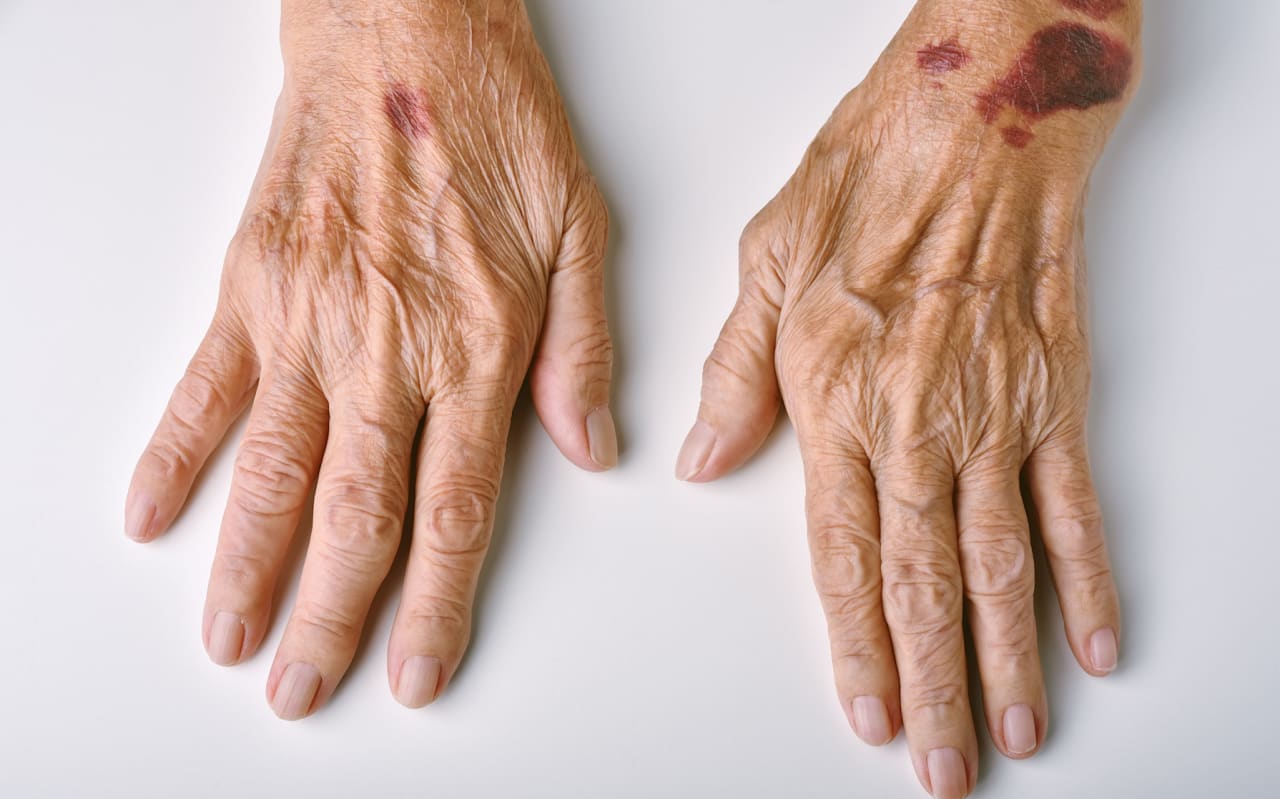 Purpura : causes et symptômes
