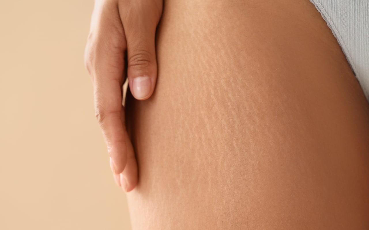 Vergeture qui gratte : nos solutions naturelles pour l’apaiser