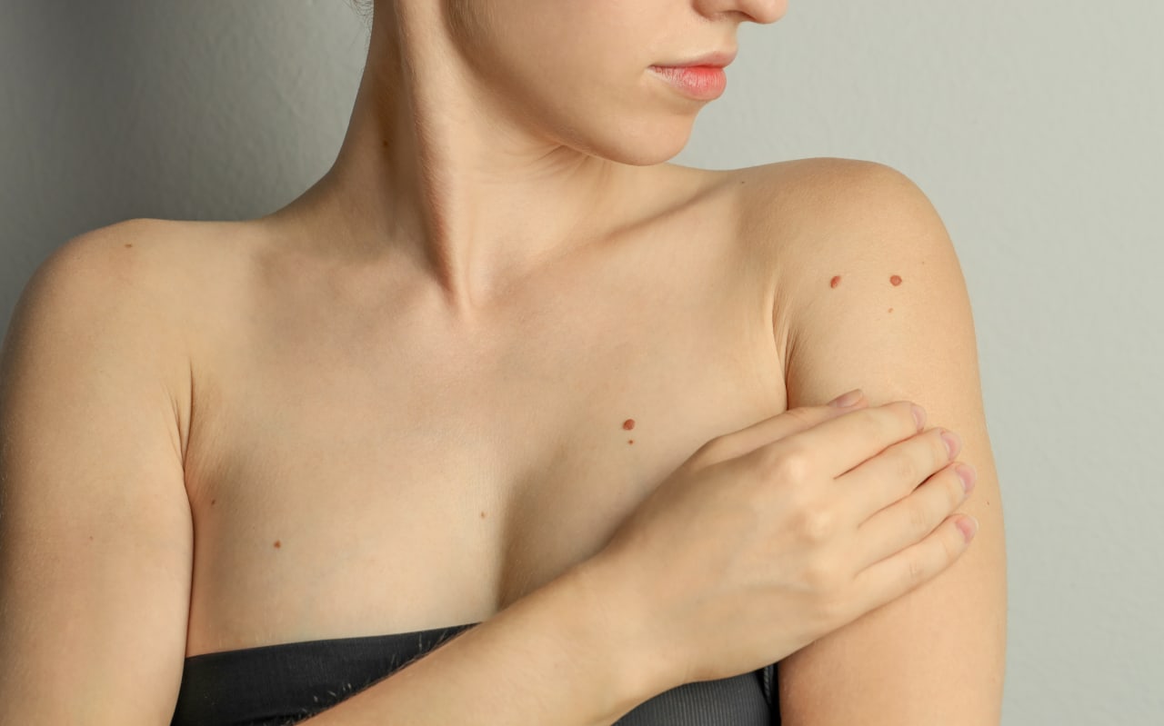 Qu'est-ce qu'un angiome de la peau ?