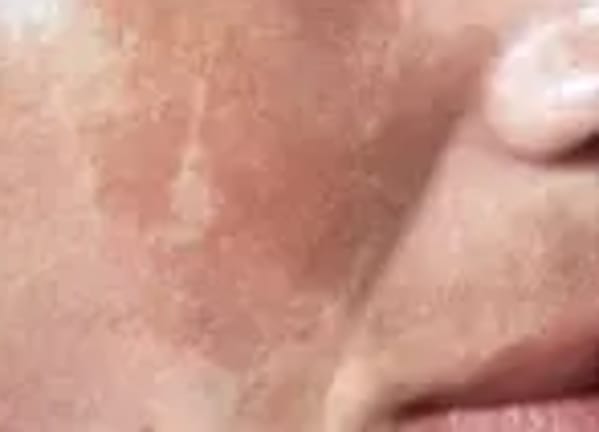 melasma